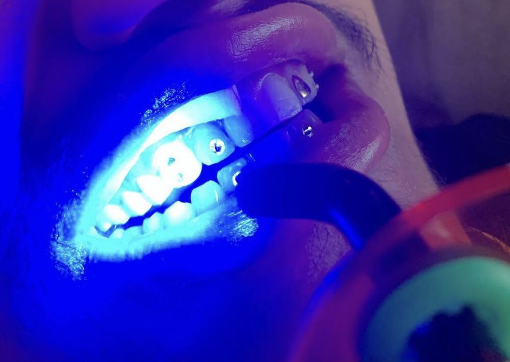 Teeth Whitening - Touch up